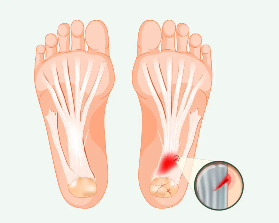 Understanding Plantar Fasciitis: Causes, Symptoms, and Treatment